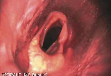 Larynx d’un cas de cornage.