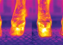 Les caméras mesurent le rayonnement infrarouge émis et mettent en évidence l’inflammation du pied. 