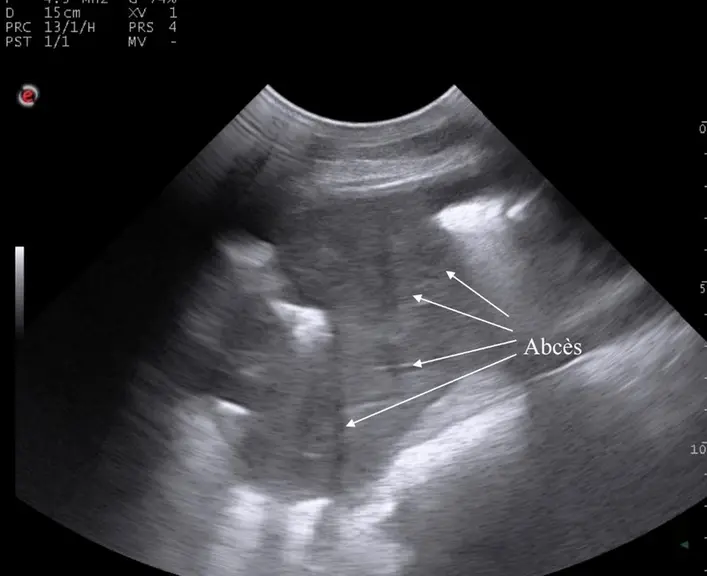 Vue échographique d'un poumon avec abcès. © Dr Vincent Herry