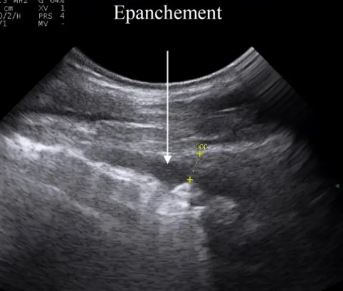 Vue échographique d'un poumon avec épanchement. © Dr Vincent Herry