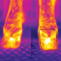 Les caméras mesurent le rayonnement infrarouge émis et mettent en évidence l’inflammation du pied.