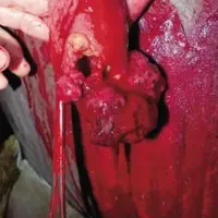 À DROITE DE LA PINCE,
une des deux tumeurs
intestinales.