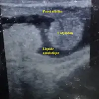 Le liquide amniotique apparaît noir sur l’échographe et les cotylédons sont bien visibles : la vache est gestante de trois mois