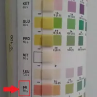 Un pH urinaire entre 5 et 6 signe une acidose.