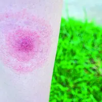 L’érythème en cocarde affirme sans aucun doute la borréliose de Lyme.