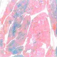 Le purpura se manifeste par la présence de multiples taches de sang dans les muscles et les abats rouges. Ces défauts rendent la viande non commercial