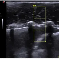 Echographie d’un veau pour déterminer le persillé de la viande