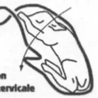 (à mettre avec "La brebis a des efforts mais rien ne sort")(refaire le schéma et enlever la flèche et "torsion anté-cervicale")Quand en fouillant, on