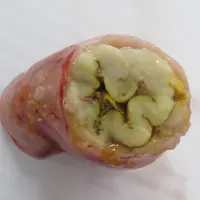 L'iléite porcine induit un épaississement de la muqueuse idéale avec de nombreux replis, prenant la forme d’un cerveau. © MSD Santé Animale