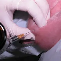 L'anesthésie à la lidocaïne doit être faite au moins 5 minutes avant la castration.