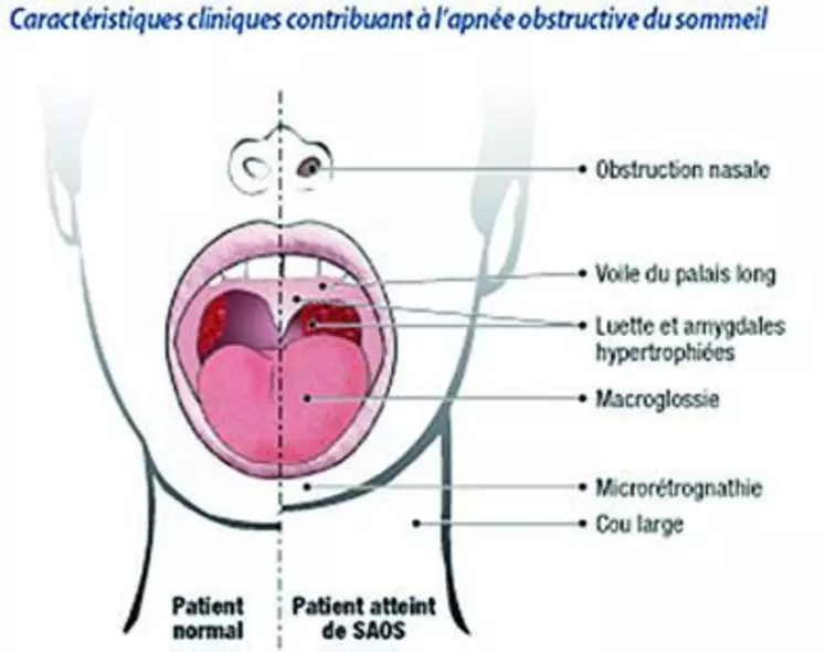 A gauche, partie du visage qui ne présente pas de problématique particulière pour le sommeil. C’est le contraire à droite.