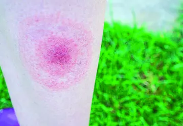 L’érythème en cocarde affirme sans aucun doute la borréliose de Lyme.