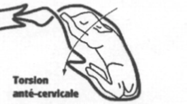 (à mettre avec "La brebis a des efforts mais rien ne sort")(refaire le schéma et enlever la flèche et "torsion anté-cervicale")Quand en fouillant, on ne sent pas le col, il peut s'agir d'une torsion utérine. Une situation qui reste heureusement rare.